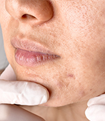 Enfermagem Dermatológica